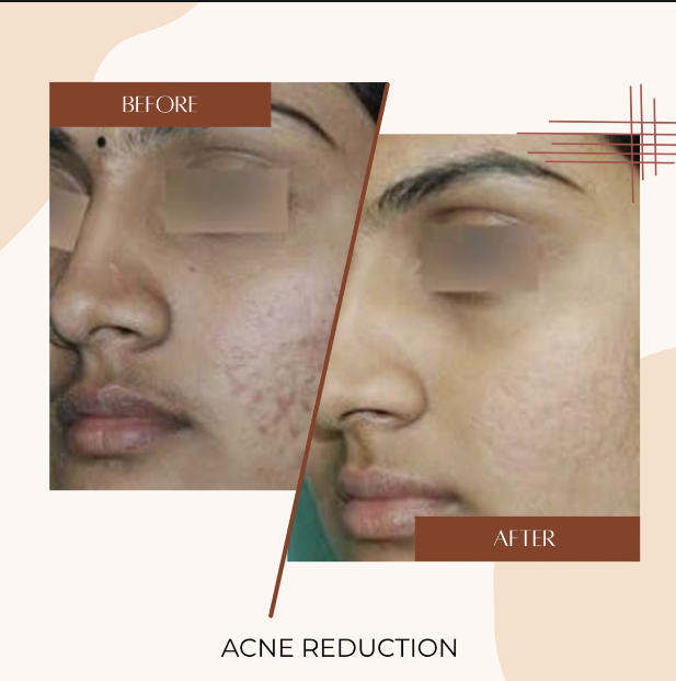 Acne Reduction Before & After