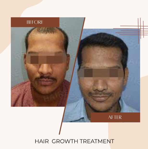Hair Growth Treatment Before & After