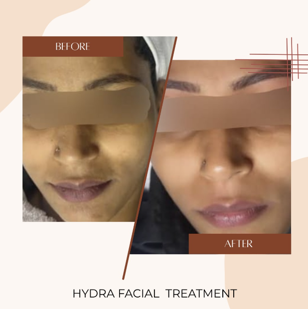 HydraFacial Treatment Before & After
