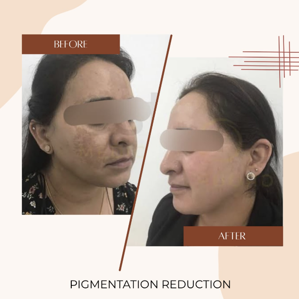 Pigmentation Reduction Before & After