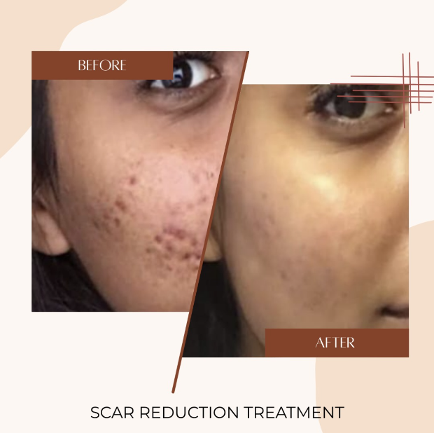 Scar Reduction Before & After