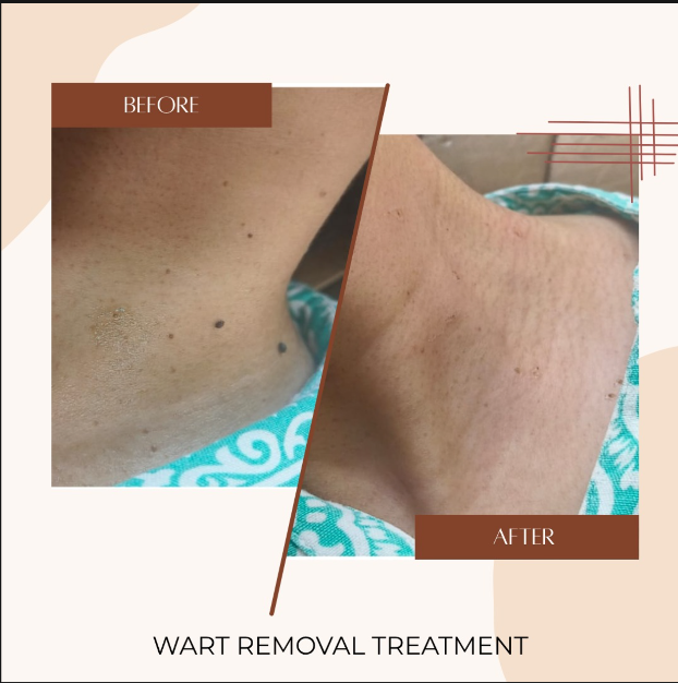 Wart Removal Treatment Before & After